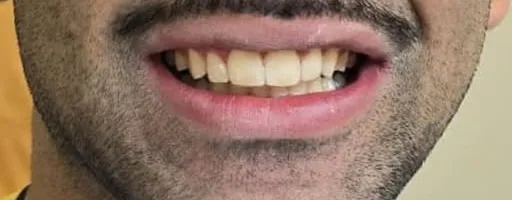 Dopo: spazio chiuso e sorriso armonioso