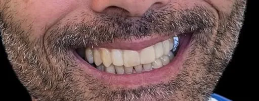 Dopo: denti regolari e più chiari