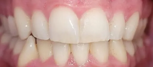 Prima del trattamento: denti frontali affollati
