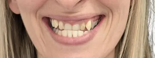 Prima del trattamento: sorriso con denti storti e inclinati in avanti