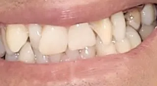 Prima del trattamento: denti affollati e irregolari