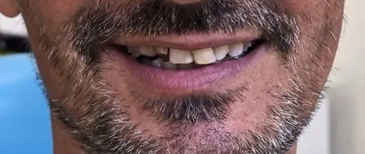 Prima del trattamento: sorriso con denti usurati e irregolari