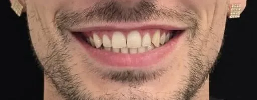 Prima del trattamento: sorriso con spazi tra i denti frontali superiori