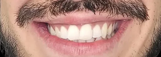 Prima del trattamento: sorriso con denti non allineati