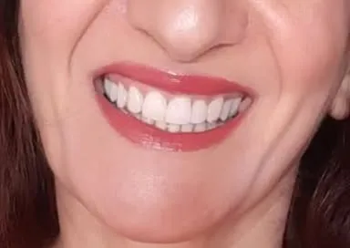 Dopo: denti frontali uniformi, senza spazio