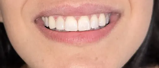 Dopo: denti frontali armoniosi in un sorriso naturale